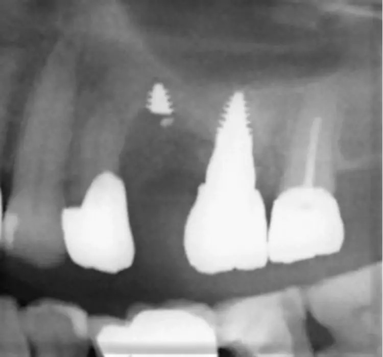 Abb. 4: Zirkonimplantate sollten Spitzen an den Arbeitsenden
aufweisen, weil diese bei Insertionskräften
über 30Ncm frakturieren können – auch noch
nach Monaten.