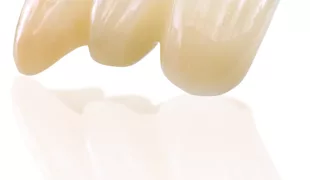 IPS e.max ZirCAD Multi Frontzahnbrücke mit hoher Festigkeit und sehr ansprechender Ästhetik.