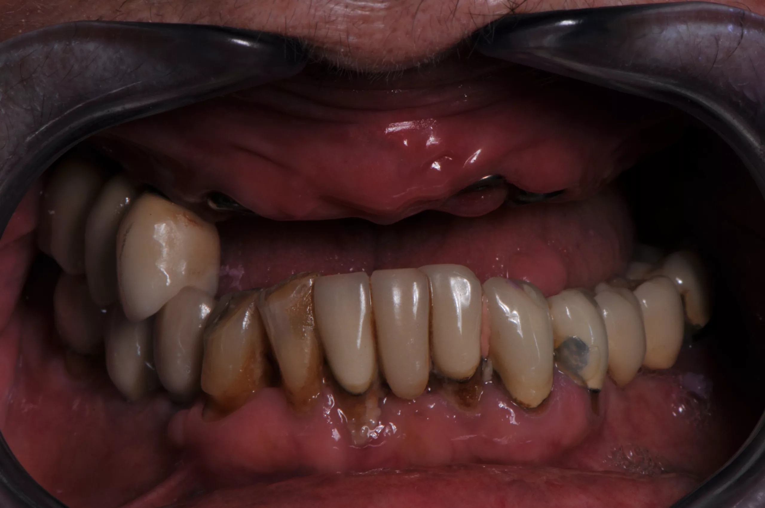 Abb. 1: Situation nach Insertion von vier Implantaten im Oberkiefer.