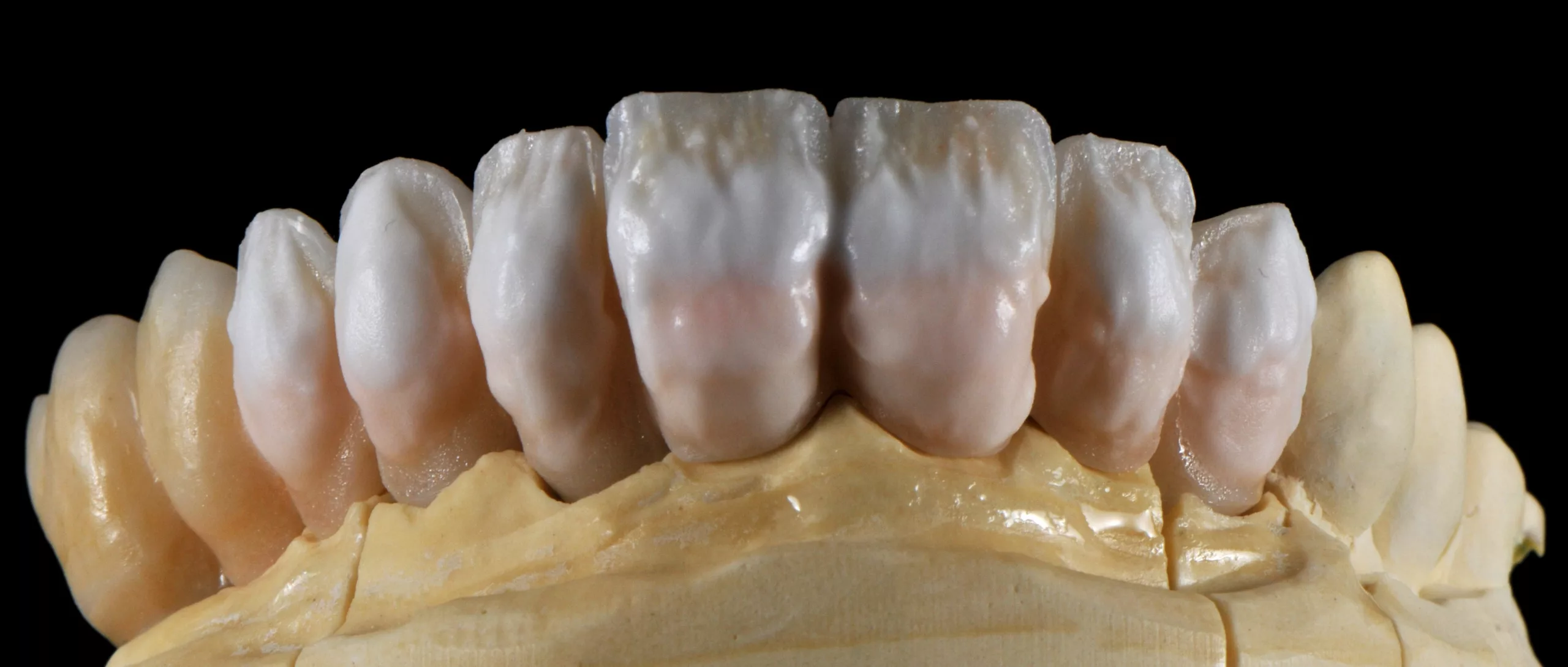 Abb. 10: Auftragen von Dentin- und Transpamassen vor der Wechselschichtung.