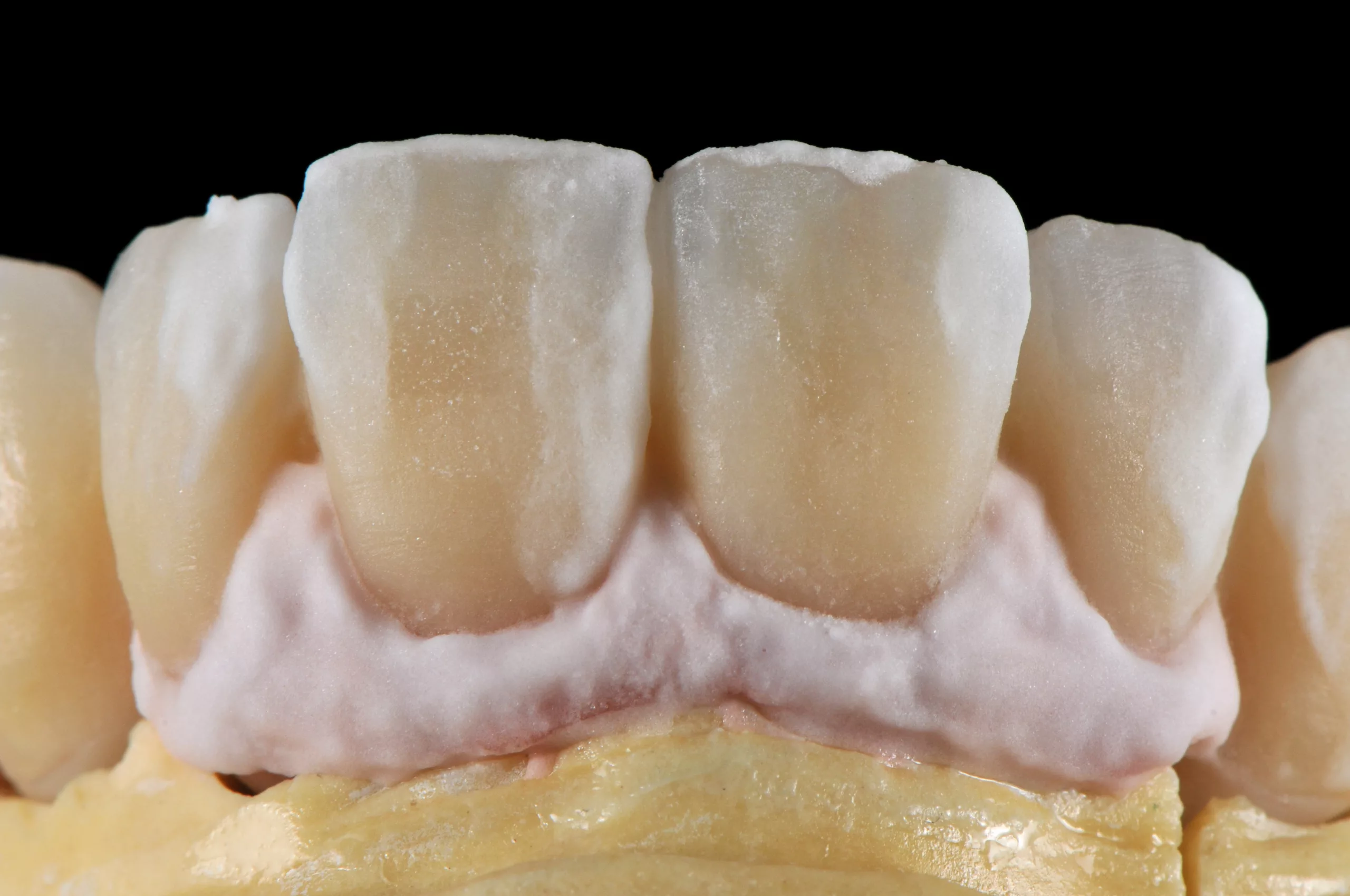 Abb. 12: Fokus auf Gingiva für den dritten Brand.