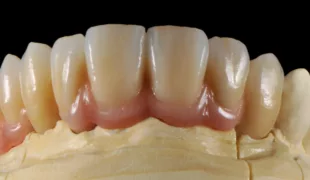 Fertige Arbeit mit IPS e.max ZirCAD Prime.