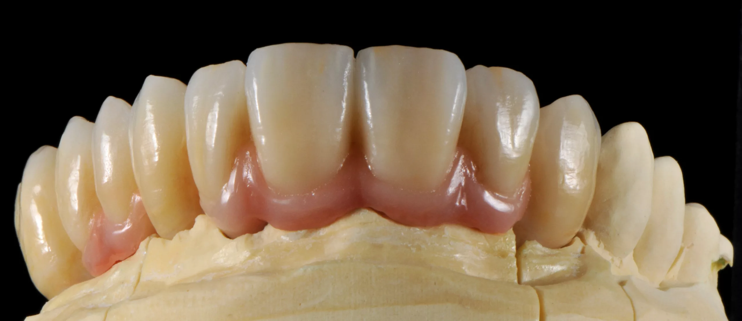 Fertige Arbeit mit IPS e.max ZirCAD Prime.