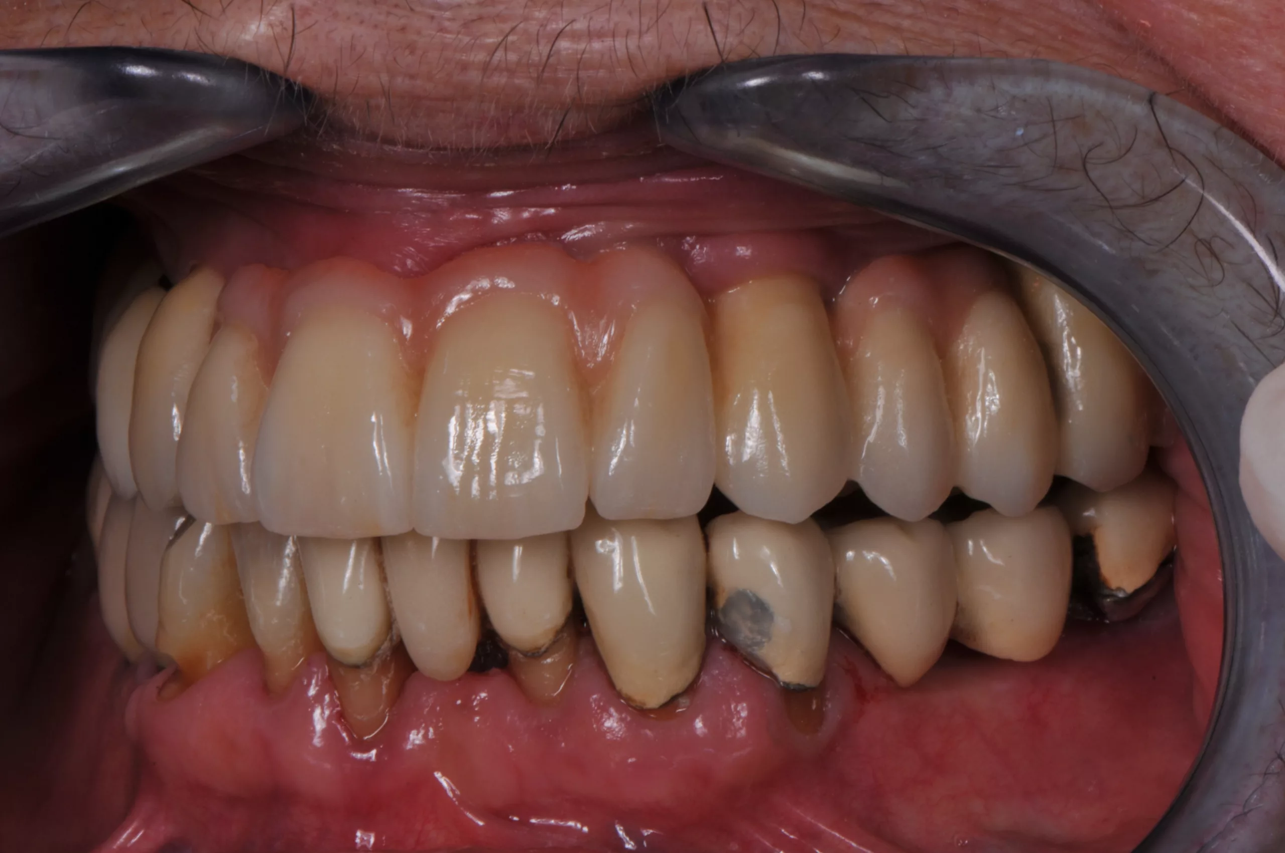 Abb. 14: Endergebnis im Patientenmund.
