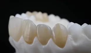 Mit einem stufenlosen, fließenden Farbverlauf vom Zahnhals zur Kaufläche/Inzisalkante ermöglicht Zirlux Anterior Multi die effiziente Imitation natürlicher Zähne.