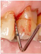 Abb. 5: Situation bei einem 74-jährigen Patienten mit Gingivitis und Parodontitis unterschiedlichen Ausmaßes. Zustand nach Parodontaltherapie.
a, b) Zahn 25 wies distobukkal und distopalatinal trotz Parodontaltherapie Sondierungstiefen von 8 mm mit Bluten nach Sondieren auf.