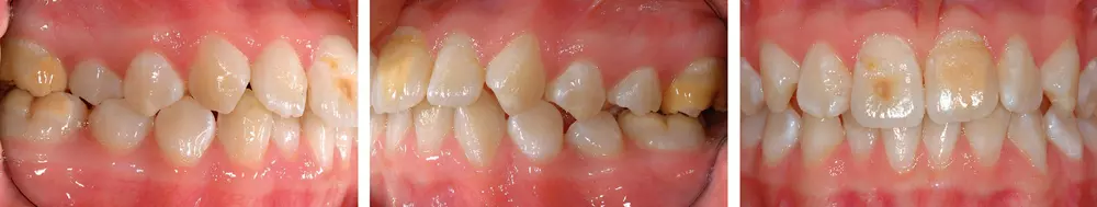 Abb. 1–3: Typisches klinisches Bild eines Patienten mit einer Molaren-Inzisiven-Hypomineralisation. Neben den bleibenden Frontzähnen weisen die Molaren deutliche Opazitäten auf.