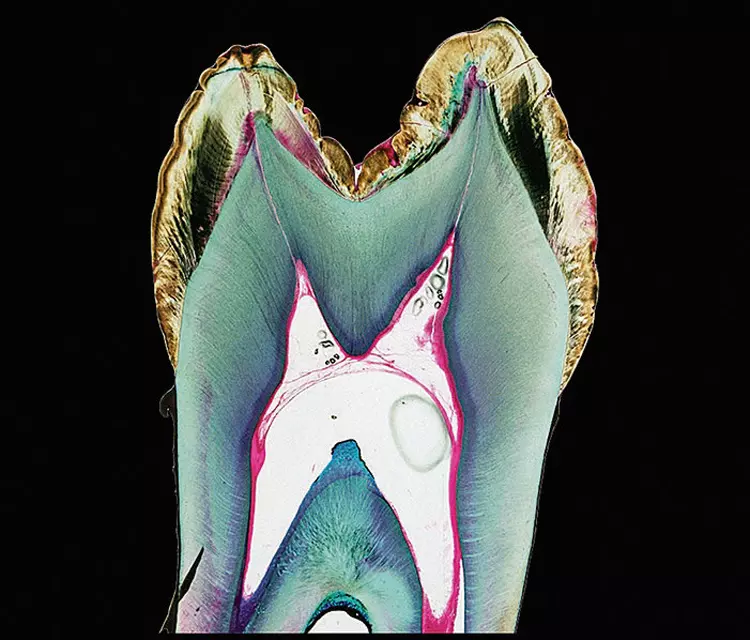 Abb. 10: Schnitt durch die Vertikalebene eines Prämolaren mit Amelogenesis imperfecta. Im Bereich der Grübchenbildung ist der Schmelz hypoplastisch verändert und weist keine Retziuslinien auf.