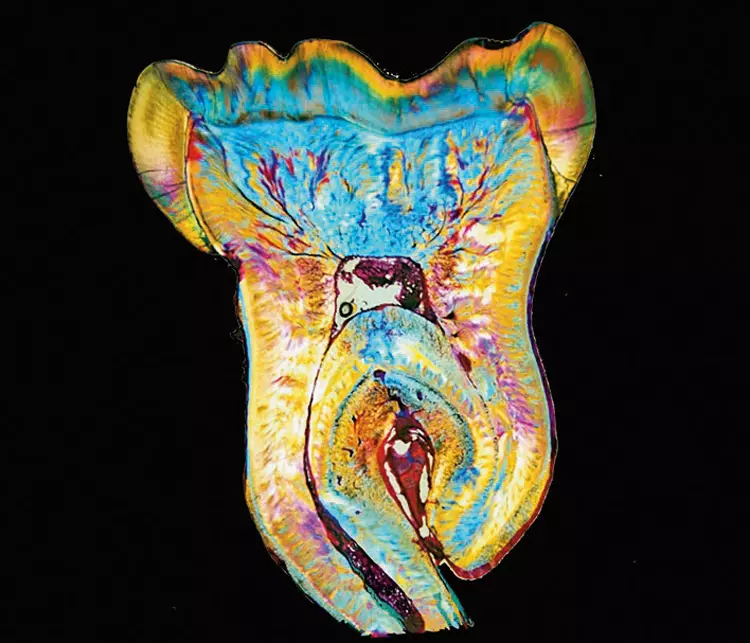Abb. 11: Der histologische Schnitt im Polarisationsmikroskop.
Gut erkennbar sind die irregulären Dentinstrukturen und die bereits stark fortgeschrittene Obliteration des Pulpakavums und der Wurzelkanäle.