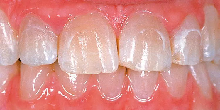 Abb. 12: Frontzähne bei einem Patienten mit Dentinogenesis imperfecta Typ II. Typisch für die Dentinogenesis imperfecta ist die bernstein-/perlmutterartige Verfärbung des Dentins, welche durch den Schmelz durchschimmert. Gut sichtbar sind die kariösen Initialläsionen nach kieferorthopädischer
Behandlung mit einer festsitzenden Apparatur.