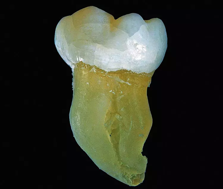 Abb. 13: Molar mit Dentinogenesis imperfecta Typ I bei einem Patienten mit Osteogenesis imperfecta. Gut erkennbar ist die bernstein-/perlmutterartige Verfärbung des Dentins.
