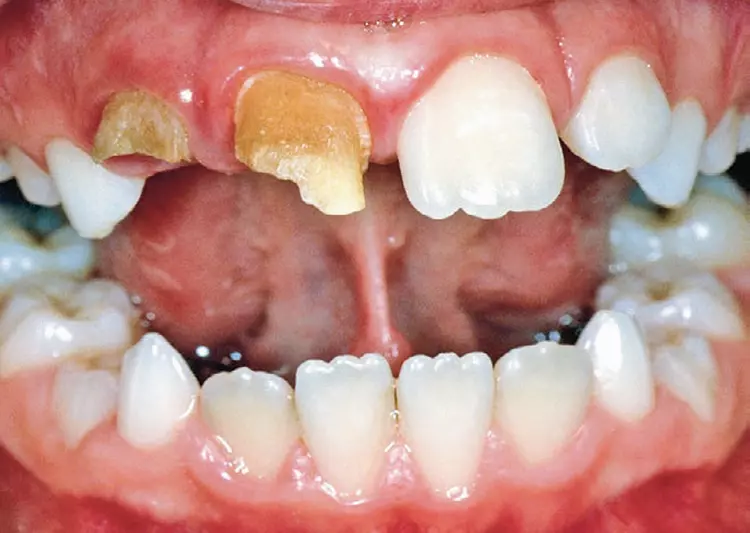Abb. 14: Odontodysplasie an den Zähnen 11 und 12. Bei der Odontodysplasie sind häufig ein oder mehrere Zähne eines Quadranten betroffen. Diese befinden sich vielfach im anterioren Oberkieferbereich.