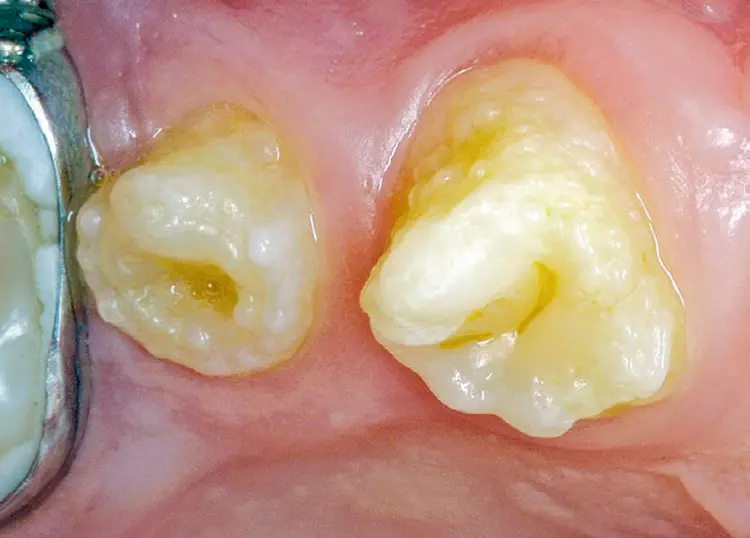 Abb. 15: Odontodysplasie an den Zähnen 14 und 15. Gut erkennbar sind die Kronenmissbildungen und gelbbraunen Verfärbungen der betroffenen Zähne.