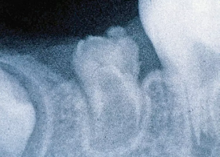 Abb. 16: Odontodysplasie an Zahn 35. Im Röntgenbild können Schmelz und Dentin kaum voneinander unterschieden werden. Durch das verschwommene und fleckige Aussehen wirkt der betroffene Zahn geisterhaft („ghost tooth“).