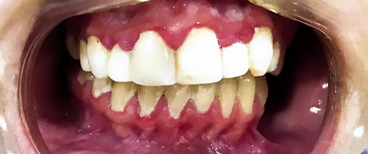 Abb. 1: Ausgangsbefund: geschwollener Gingivasaum, massive Plaqueanlagerungen, Blutungen.
