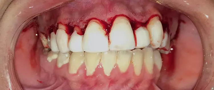 Abb. 2: Zustand nach OXYSAFE-Anwendung und Débridement.