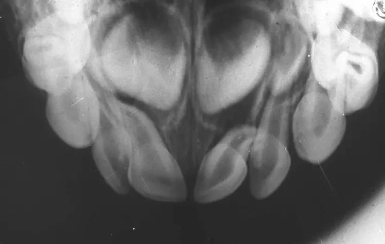 Abb. 4: Die OK-Aufbissaufnahme ermöglicht eine gute Beurteilung der Lagebeziehung von traumatisiertem Milchzahn und Keim des permanenten Nachfolgers.