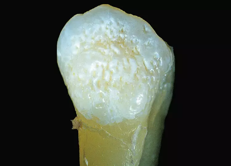 Abb. 9: Prämolar mit Grübchenbildung auf der Bukkalfläche. Das Erscheinungsbild dieser Zähne kann durch Einlagerung von Farbstoffen in die Grübchen sehr auffällig werden.
