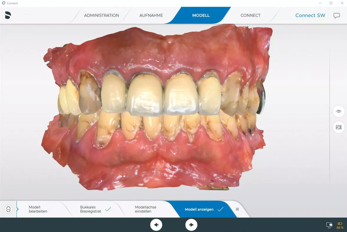 Abb. 2: Intraoralscan zur weiteren Planung und Sicherung der Ausgangsbisslage.