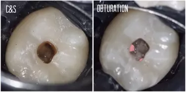 Die klinische Situation nach Aufbereitung der Wuzelkanäle unter Verwendung von TruNatomy (Dentsply Sirona).