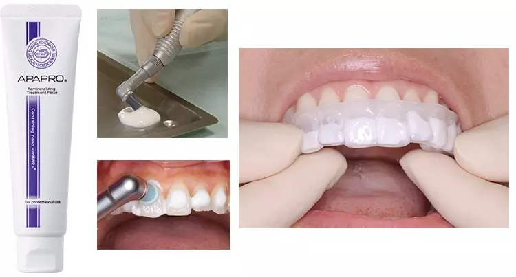 Abb. 3-6: Das remineralisierende Hydroxyapatit-haltige Mittel APAPRO von SANGI wird nach der PMPR entweder mit einem Gummikelch oder mit einer Schiene appliziert.