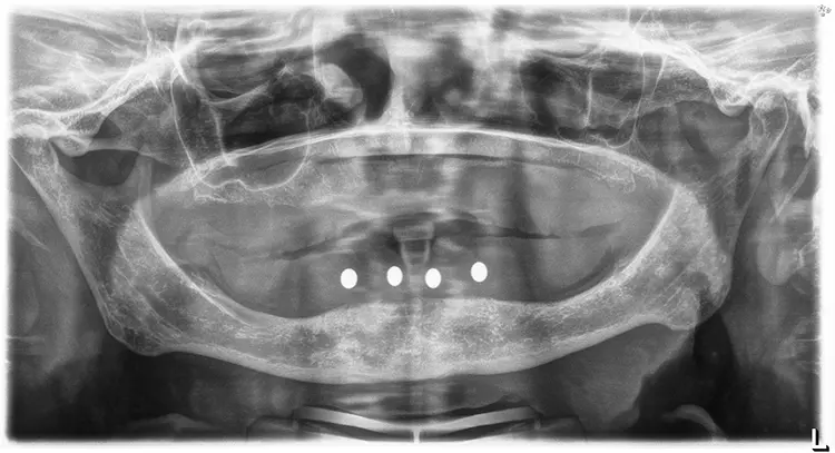 Abb. 2: Kugelmessaufnahme zur Implantatplanung.