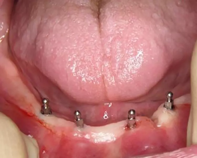 Abb. 3: Situs nach Insertion von 4 MDI
Miniimplantaten am OP-Tag.