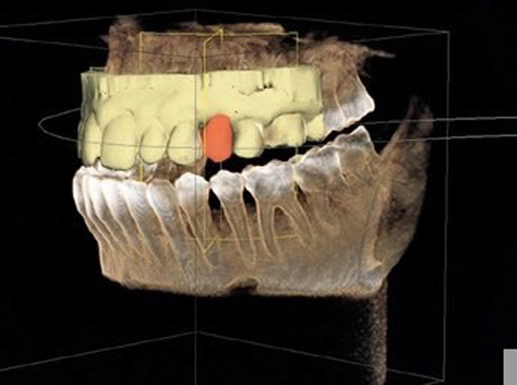 Integration der CAD/CAM-Daten in den DVT-Datensatz zur restaurationsgerechten digitalen Implantatplanung.