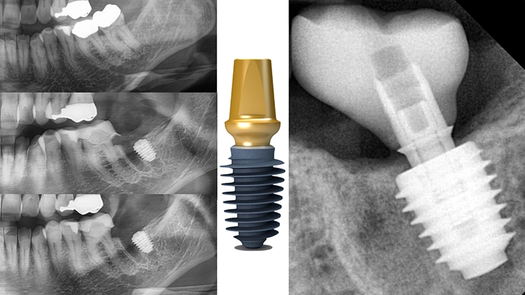 Abb. 6: Molar nach Implantation mit regenerativer Therapie (PRGF-Verfahren).