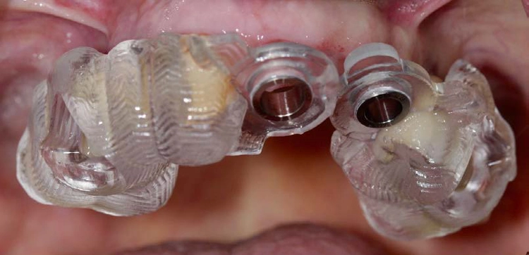 Chirurgische Bohrschablone zur Platzierung von Implantatpfeilern, gefertigt auf Basis von DICOM-Daten aus dem DVT.