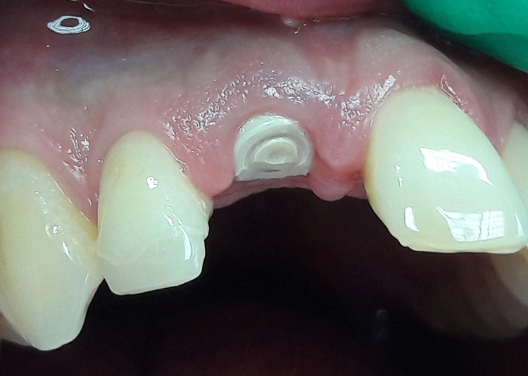 Abb. 1-4: So soll es sein: Bei schwieriger Ausgangssituation (frakturierter Zahn 11) wird nach Extraktion und lappenlosem chirurgischem Eingriff (Vorteil: minimale Weichgewebsschädigung) das Implantat mit einer Einzelkrone versorgt und so die ursprüngliche harmonische Rot-weiß-Ästhetik wiederhergestellt.