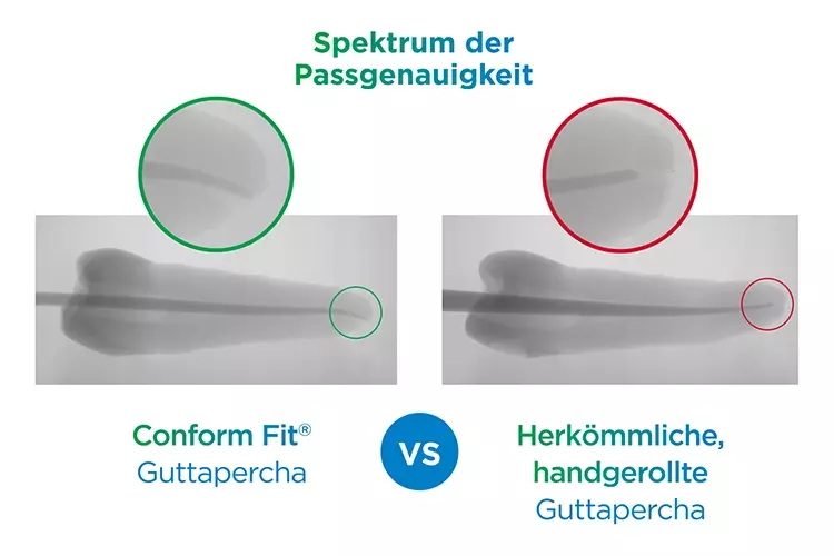 Der Anwender hat die Wahl: zum Beispiel Guttaperchastifte mit variabler
Konizität, passend zur letzten Aufbereitungsfeile (Conform Fit Technologie,
Dentsply Sirona), oder herkömmliche, handgerollte Guttapercha.