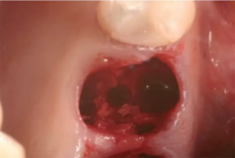 Abb. 10: Das aufbereitete Implantatbett.