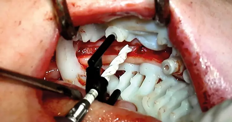 Abb. 10: Die Implantatbohrung und -insertion am Beispiel des 3. Quadranten:
Das Schienensystem SDS BOX FULL NAVIGATION SYSTEM ermöglicht mit den lateralen
Führungshülsen bei ausreichender Wasserkühlung eine uneingeschränkte
Sicht auf das Insertionsgebiet, ohne metallischen Abrieb für das eröffnete Knochenlager
in Kauf zu nehmen.
