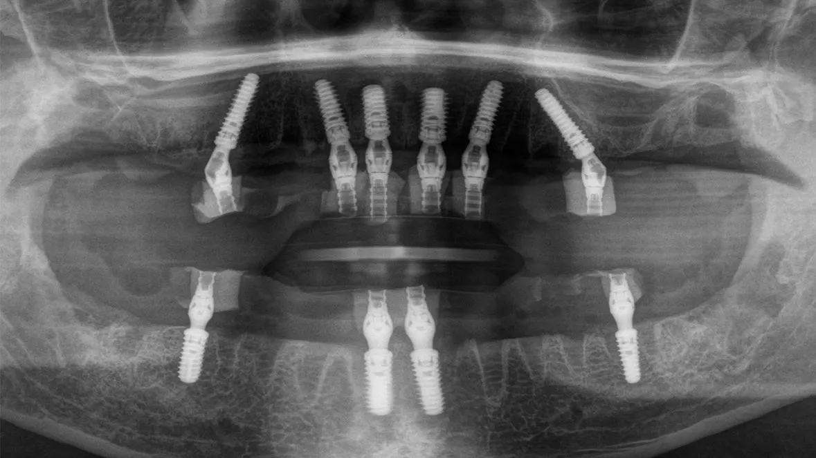 Abb. 11: Radiologische Kontrolle der sofortversorgten Implantate im Ober- und Unterkiefer (copaSky, Bredent Medical, Senden).