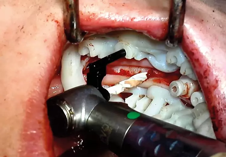 Abb. 11: Die Implantatbohrung und -insertion am Beispiel des 3. Quadranten:
Das Schienensystem SDS BOX FULL NAVIGATION SYSTEM ermöglicht mit den lateralen
Führungshülsen bei ausreichender Wasserkühlung eine uneingeschränkte
Sicht auf das Insertionsgebiet, ohne metallischen Abrieb für das eröffnete Knochenlager
in Kauf zu nehmen.