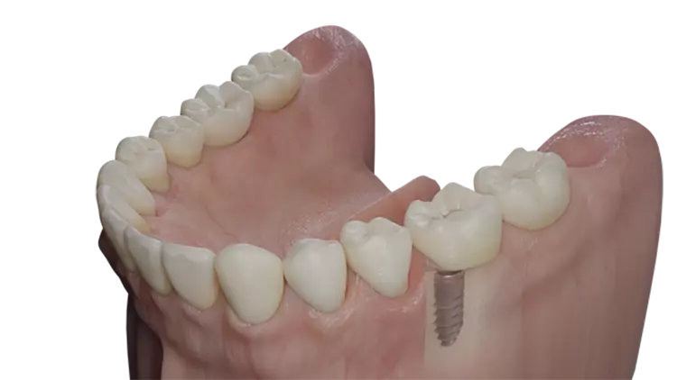 Abb. 11: Die Kronenlänge der Implantatkrone wird mit derjenigen des kontralateralen Zahns verglichen.