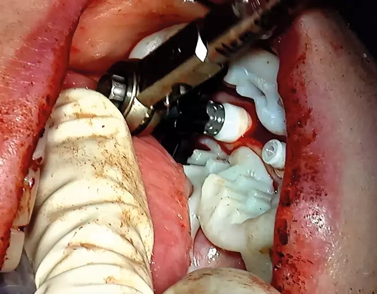 Abb. 12: Die Implantatbohrung und -insertion am Beispiel des 3. Quadranten:
Das Schienensystem SDS BOX FULL NAVIGATION SYSTEM ermöglicht mit den lateralen
Führungshülsen bei ausreichender Wasserkühlung eine uneingeschränkte
Sicht auf das Insertionsgebiet, ohne metallischen Abrieb für das eröffnete Knochenlager
in Kauf zu nehmen.