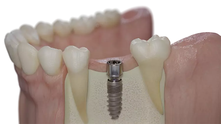 Abb. 12: Chirurgische Verschlussschraube und Gingivaformer zugleich: Der Shuttle macht im Gegensatz zu anderen lappenlosen Protokollen eine Wiedereröffnung der Gingiva in der prothetischen Phase unnötig. Dadurch wird unter anderem das Einwandern von Bakterien an der Schnittstelle von Implantat und Abutment verhindert, welches Untersuchungen von Romanos et al. zufolge ansonsten zu Knochenverlust
führen könnte [12].