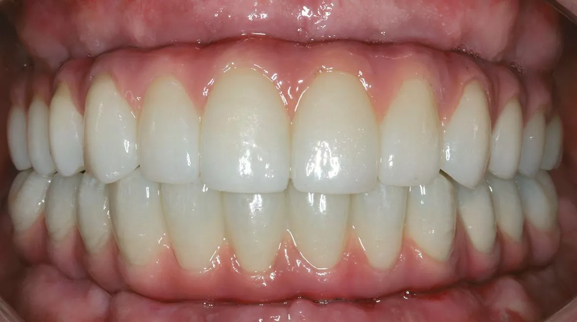 Abb. 13: Versorgung im Ober- und Unterkiefer mit zirkulärer Brücken auf axial verschraubten Abutments (unicone Abutment, copaSKY, Bredent Medical).