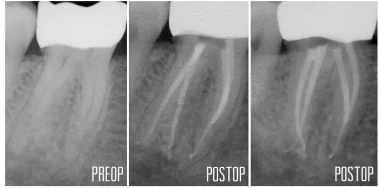Die klinische Situation nach Aufbereitung der Wuzelkanäle (l.) und nach der Obturation unter Verwendung des Endodontie-Konzepts TruNatomy (Dentsply Sirona).