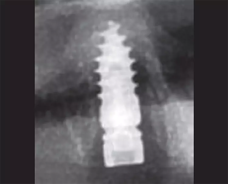 Abb. 30: Das inserierte Implantat im Röntgenbild.