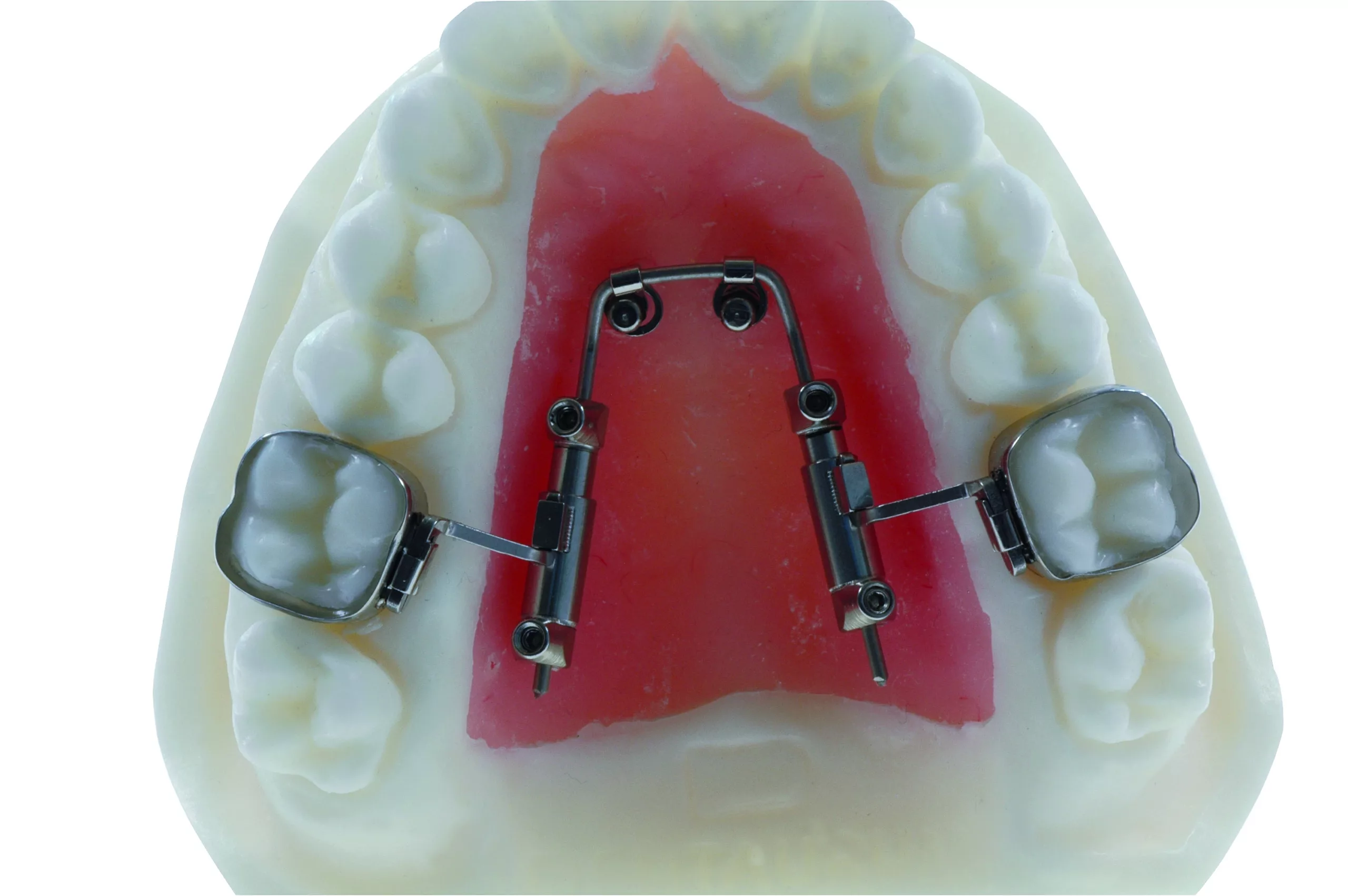 Um diese Apparatur dreht sich der gesamte Kurs: amda® – advanced molar distalization appliance.