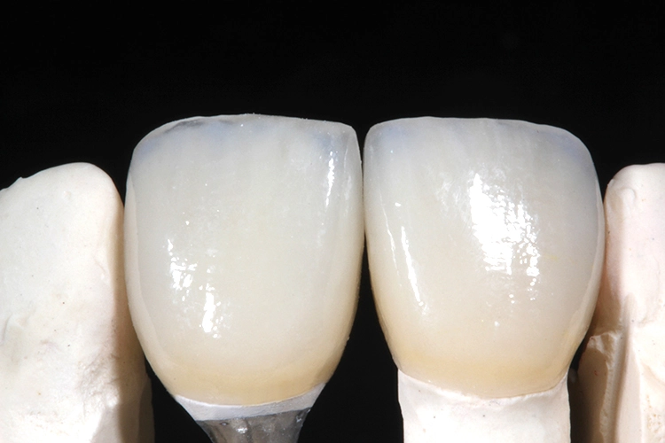 Die fertiggestellte Frontzahnrestauration auf dem Modell. Die Kronen wurden auf Abutments aus PEEK-basierendem Polymer (BioHPP, Bredent) gefertigt.