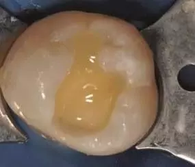 Tetric EvoFlow Bulk Fill vor der Polymerisation