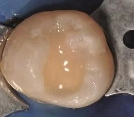 Tetric EvoFlow Bulk Fill nach der Polymerisation