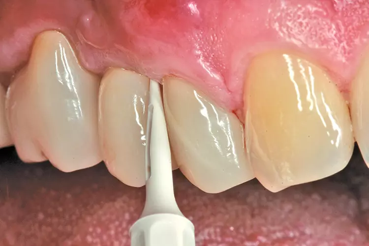 Abb. 2: Schall-Scaling und Reinigung des Implantats.