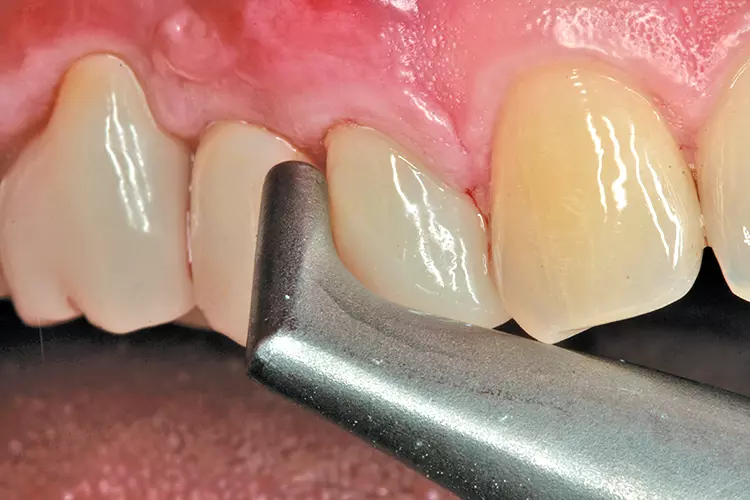 Abb. 3: Weitere mechanische Reinigung des Implantats mit PWS.