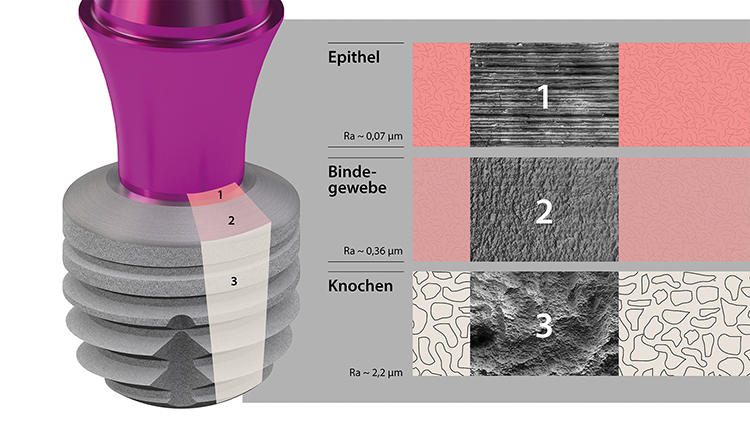 Eine Mikrostrukturierung der Oberfläche, so wie sie die copaSKY Implantate von bredent aufweisen, eignet sich ideal für die Anlagerung des Bindegewebes aber auch des Knochens.