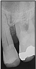 Abb. 5 c) Röntgenbild mit Darstellung des starken interdentalen Knochenabbaus.